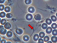 Image of fibrin spiculae