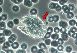 Phase Contrast image shows cholesterol in the bloodstream